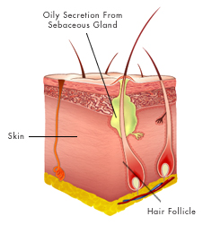 Acne Treatment