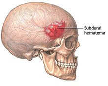 Brain Hemorrhage Symptoms