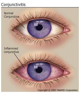 Conjunctivitis