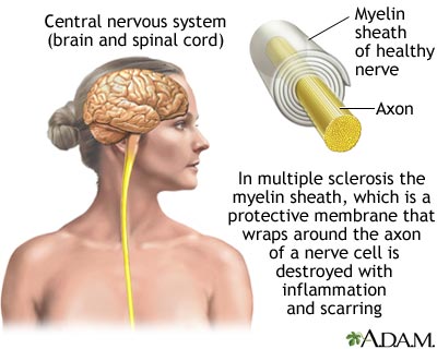 Multiple Sclerosis