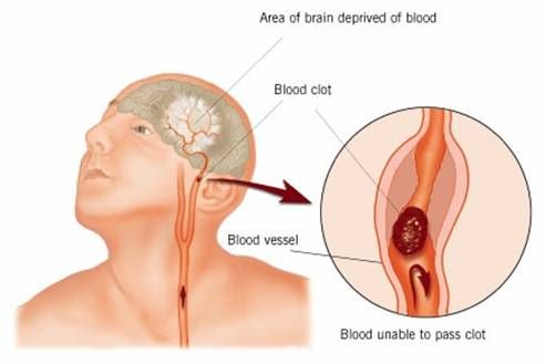 Stroke Symptoms and Signs