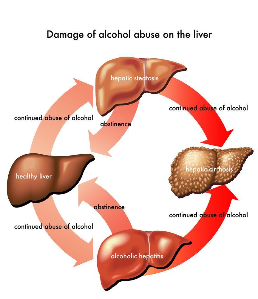 Alcoholic hepatitis