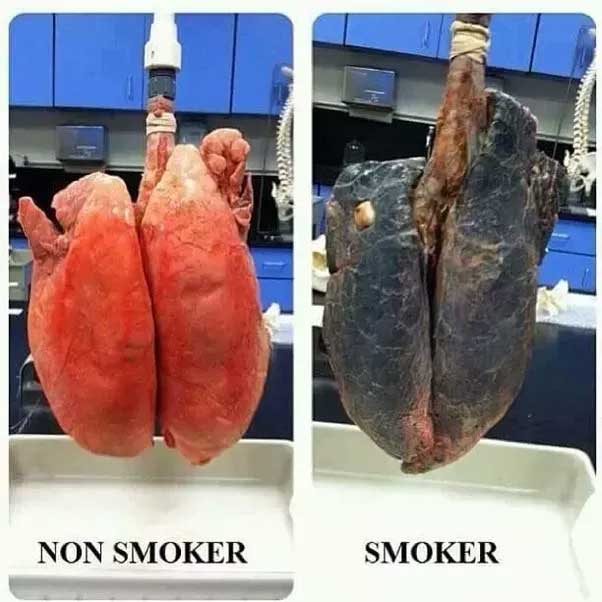 Effect of Smoking on Lungs